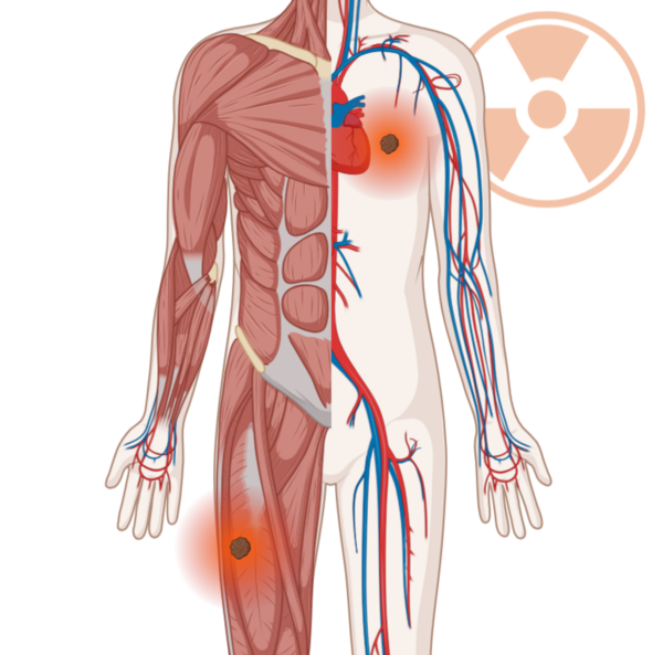Schematische, anatomische Darstellung des Körpers mit leuchtenden Tumoren im Brustkorb und im Oberschenkel. Im Hintergrund ein Strahlensymbol.