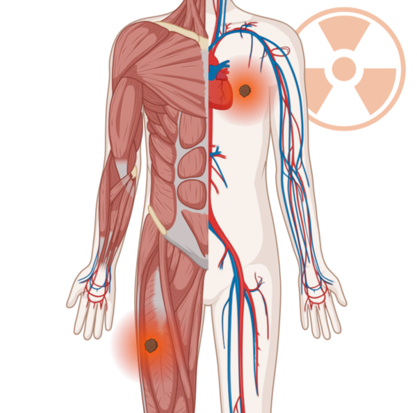 Schematische, anatomische Darstellung des Körpers mit leuchtenden Tumoren im Brustkorb und im Oberschenkel. Im Hintergrund ein Strahlensymbol.