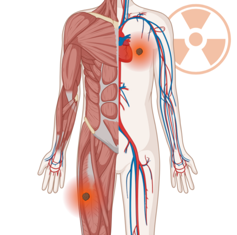 Schematische, anatomische Darstellung des Körpers mit leuchtenden Tumoren im Brustkorb und im Oberschenkel. Im Hintergrund ein Strahlensymbol.