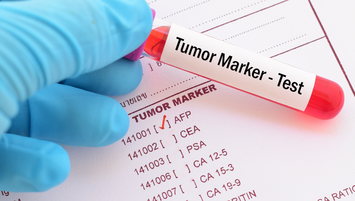 Bluttest auf Tumormarker , © Jarun Ontakrai, Shutterstock Auf einem Ausdruck stehen Abkürzungen von mehreren Tumormarkern, bei “AFP“ ist ein roter Haken. Im Vordergrund hält eine Hand mit OP-Handschuhen ein Röhrchen mit einer Blutprobe auf der “Tumor Marker-Test“ steht.