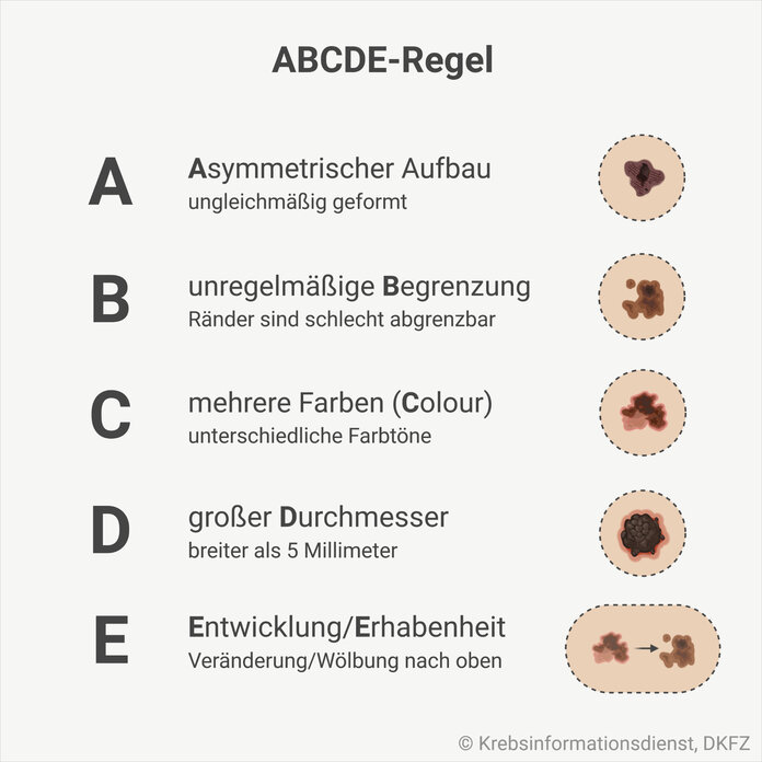 abcde-regel, © Krebsinformationsdienst, DKFZ, erstellt mit BioRender.com Eine Grafik zeigt die ABCDE-Regel: A steht für einen asymmetrischen Aufbau, B für eine unregelmäßige Begrenzung, C für Colour – verschiedene Farben, D für einen großen Durchmesser und E für Erhabenheit oder Entwicklung.