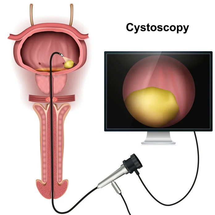 Blasenspiegelung (Zystoskopie) , © medicalstocks, iStock (modifiziert) Anatomische Darstellung der Harnblase und Harnröhre beim Mann mit einem Untersuchungsgerät zur Blasenspiegelung (Zystoskop). Daneben ist ein vergrößerter Blasentumor auf einem Computer-Monitor dargestellt.