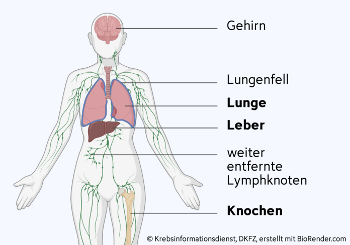 Grafische Darstellung der Gewebe, in die Brustkrebs am häufigsten streut: Knochen, Lunge, Leber, weiter entfernte Lymphknoten, Gehirn und Lungenfell.