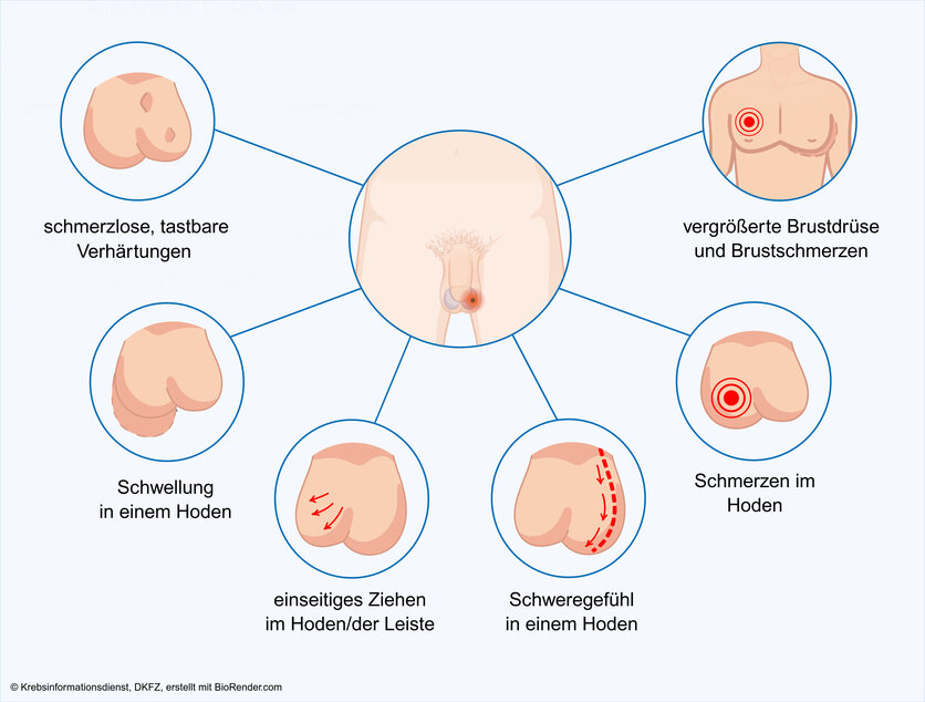 Graphische Darstellung der verschiedenen Symptome, die Hodenkrebs verursachen kann: ein Schweregefühl in einem Hoden, ein einseitiges Ziehen im Hoden oder in der Leiste, eine tastbare Verhärtung innerhalb eines Hodens oder an seiner Oberfläche, Schmerzen im Hoden, Vergrößerung der Brustdrüse und Schmerzen in der Brust, Schwellung eines Hodens.
