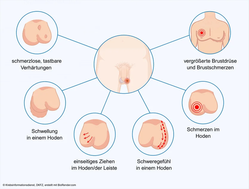 Symptome bei Hodenkrebs, © Krebsinformationsdienst, DKFZ; erstellt mit Biorender.com Graphische Darstellung der verschiedenen Symptome, die Hodenkrebs verursachen kann: ein Schweregefühl in einem Hoden, ein einseitiges Ziehen im Hoden oder in der Leiste, eine tastbare Verhärtung innerhalb eines Hodens oder an seiner Oberfläche, Schmerzen im Hoden, Vergrößerung der Brustdrüse und Schmerzen in der Brust, Schwellung eines Hodens.