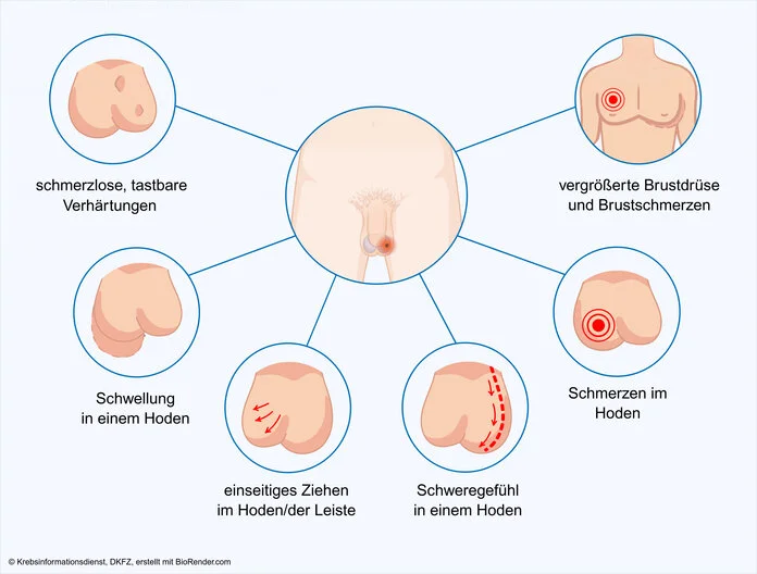 Symptome bei Hodenkrebs, © Krebsinformationsdienst, DKFZ; erstellt mit Biorender.com Graphische Darstellung der verschiedenen Symptome, die Hodenkrebs verursachen kann: ein Schweregefühl in einem Hoden, ein einseitiges Ziehen im Hoden oder in der Leiste, eine tastbare Verhärtung innerhalb eines Hodens oder an seiner Oberfläche, Schmerzen im Hoden, Vergrößerung der Brustdrüse und Schmerzen in der Brust, Schwellung eines Hodens.