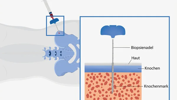 Grafische Darstellung der Knochenmarkaspiration. Bild: Asena Tunali Bei der Knochenmarkuntersuchung wirde eine Biopsienadel durch die Haut in den Beckenknochen gestochen und das Knochenmark angesaugt.