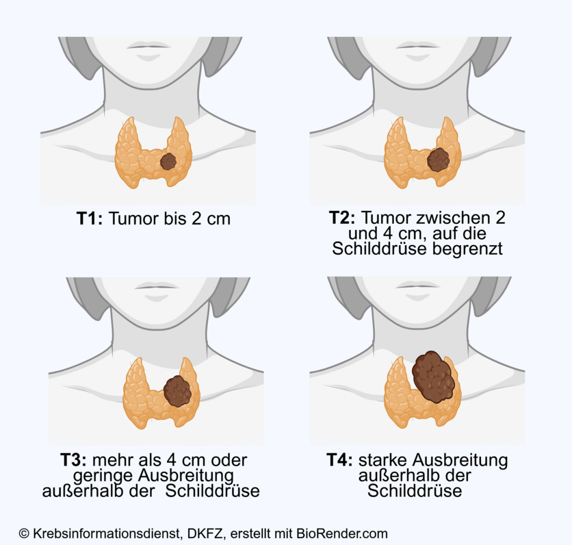 In den Stadien T1 bis T3 ist Schilddrüsenkrebs vorwiegend auf die Schilddrüse begrenzt, im Stadium 4 breitet sich der Tumor über die Schilddrüse hinaus aus.