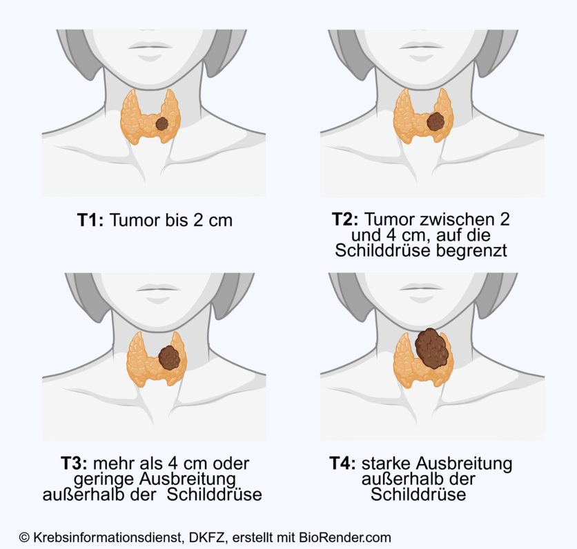 In den Stadien T1 bis T3 ist Schilddrüsenkrebs vorwiegend auf die Schilddrüse begrenzt, im Stadium 4 breitet sich der Tumor über die Schilddrüse hinaus aus.