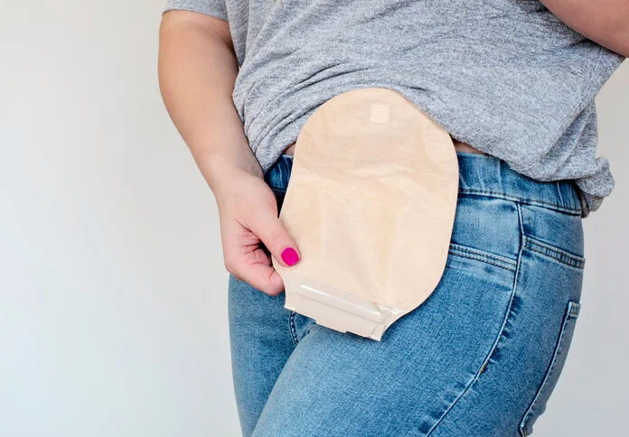Stomabeutel, © Matuska, Shutterstock Frau trägt einen Stomabeutel.