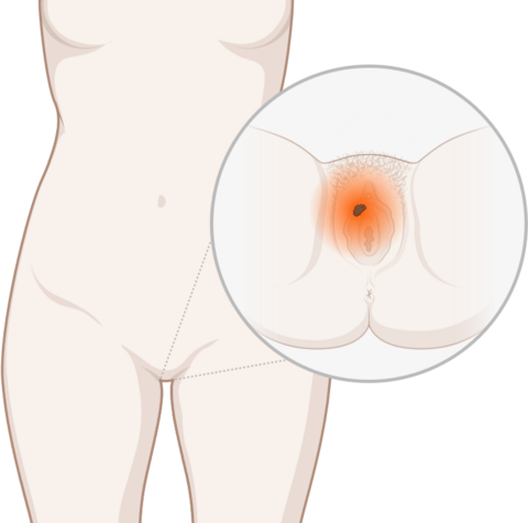 Schematische, anatomische Darstellung der Vulva und leuchtendem Tumor.