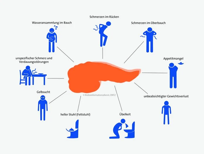 Symptome Bauchspeicheldrüsenkrebs, © Krebsinformationsdienst, DKFZ; erstellt von Lena Passek Mindmap verschiedener Beschwerden, die auf Bauchspeichelkrebs hinweisen können.