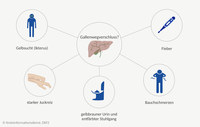 Gallenwegsverschluss, © Krebsinformationsdienst, DKFZ; erstellt mit BioRender.com Mindmap mit Symptomen bei einem Gallenwegverschluss: Gelbsucht, starker Juckreiz der Haut, gelbbrauner Urin und entfärbter Stuhlgang, Bauchschmerzen und Fieber.