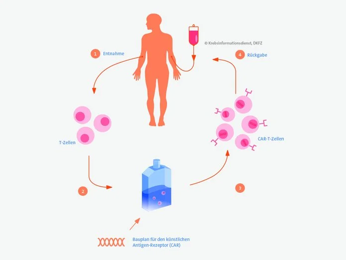 Ablauf einer CAR-T-Zell-Therapie, © Krebsinformationsdienst, DKFZ Schematische Darstellung des Ablaufs einer CAR-T-Zell-Therapie