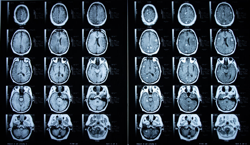 MRT-Aufnahme , © Dean Hoch, Thinkstock Aufnahme einer Magnetresonanztomographie (MRT) des Gehirns mit (rechts) und ohne (links) Kontrastmittel.