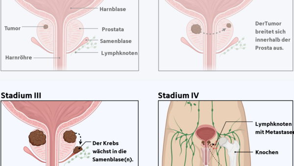 Graphische Darstellung der 4 Tumorstadien bei Prostatakrebs und die unterschiedliche Tumorgröße und Ausbreitung im Körper.