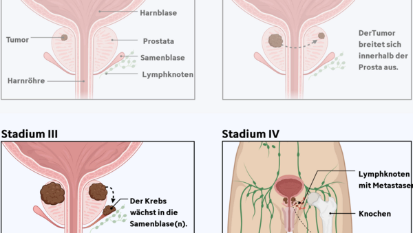 Graphische Darstellung der 4 Tumorstadien bei Prostatakrebs und die unterschiedliche Tumorgröße und Ausbreitung im Körper.