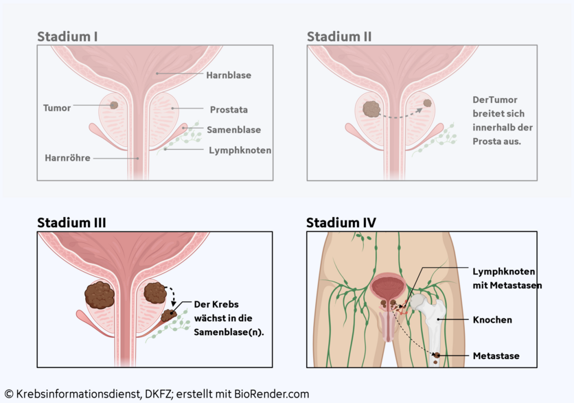 Tumorstadien bei Prostatakrebs, © Krebsinformationsdienst, DKFZ, angepasst nach "Prostate Cancer Stages" von BioRender.com (2023), abgerufen von https://app.biorender.com/biorender-templates Graphische Darstellung der 4 Tumorstadien bei Prostatakrebs und die unterschiedliche Tumorgröße und Ausbreitung im Körper.