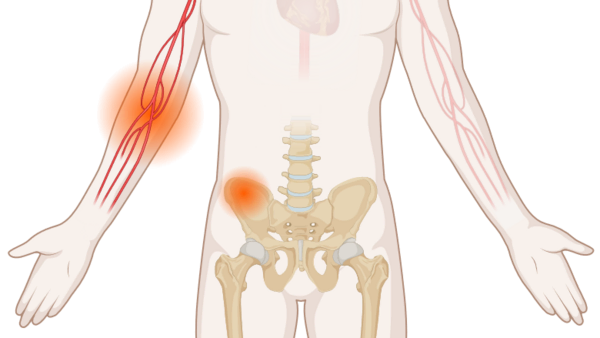Multiples Myelom, © Krebsinformationsdienst, DKFZ; erstellt mit BioRender.com Schematische, anatomische Darstellung des Körpers mit leuchtenden Tumoren an Blutgefäßen und Beckenknochen.