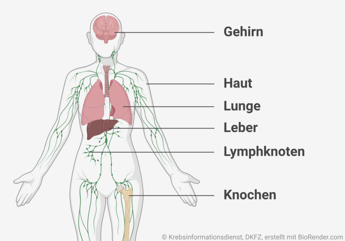 Häufige Metastasenorte, © Krebsinformationsdienst, DKFZ; erstellt mit BioRender.com grafische Darstellung von Organen und Geweben, in die Krebs häufig metastasiert