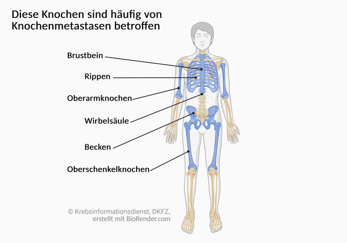 Darstellung des menschlichen Skeletts. Eingefärbt sind: Brustbein, Rippen, Wirbelsäule, Becken sowie Oberarm- und Oberschenkelknochen.