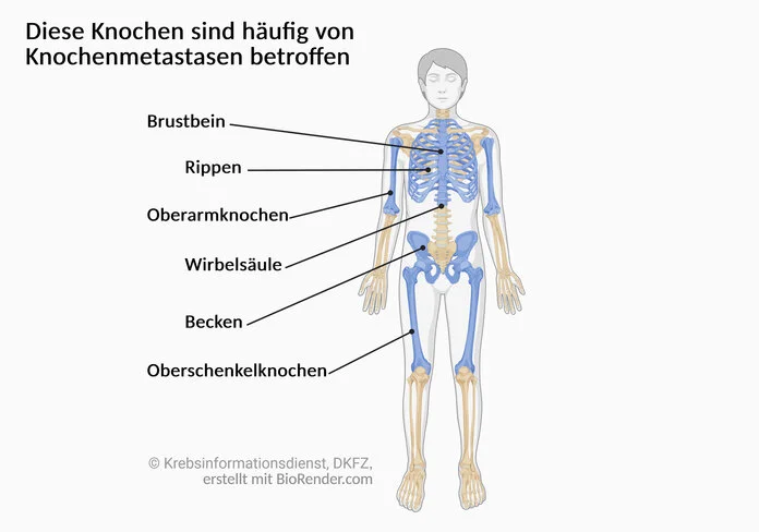 Darstellung des menschlichen Skeletts. Eingefärbt sind: Brustbein, Rippen, Wirbelsäule, Becken sowie Oberarm- und Oberschenkelknochen.