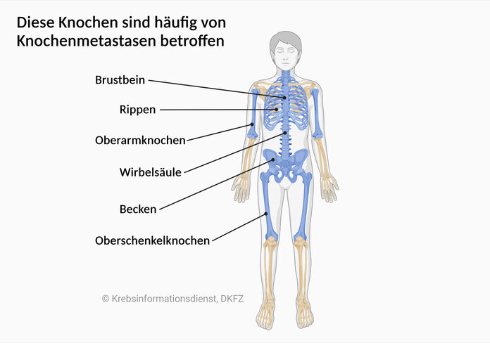 Auftreten von Knochenmetastasen, © Krebsinformationsdienst, DKFZ, erstellt mit Biorender.com Darstellung des menschlichen Skeletts. Eingefärbt sind: Brustbein, Rippen, Wirbelsäule, Becken sowie Oberarm- und Oberschenkelknochen.