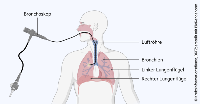 Bronchoskopie (Lungenspiegelung), © Krebsinformationsdienst, DKFZ; erstellt mit BioRender.com Bronchoskopie: Der biegsame Schlauch des Bronchoskops wird durch den Mund, durch die Luftröhre bis hin die Bronchien vorgeschoben.