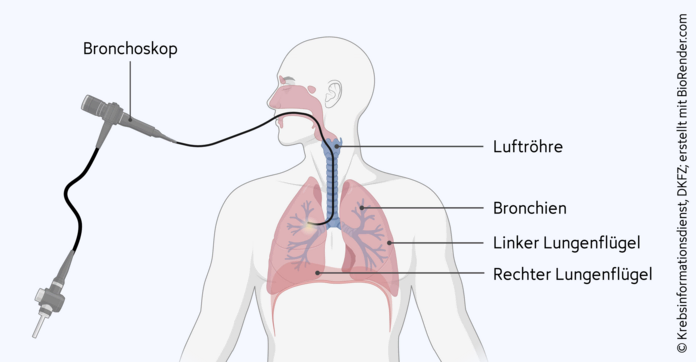 Bronchoskopie (Lungenspiegelung), © Krebsinformationsdienst, DKFZ; erstellt mit BioRender.com Bronchoskopie: Der biegsame Schlauch des Bronchoskops wird durch den Mund, durch die Luftröhre bis hin die Bronchien vorgeschoben.