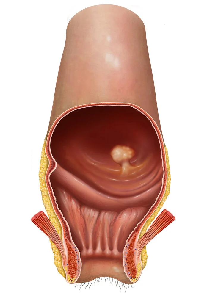 Darmpolyp im Darm, © MediDesign Frank Geisler grafische Darstellung eines Darmpolypem im Darm