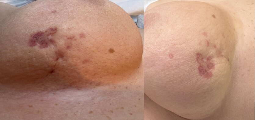 Zwei klinische Fotografien einer rechten Brust aus verschiedenen Blickwinkeln, die großflächige, rötlich-violette Hautverfärbungen und eine kleine Narbe zeigen.