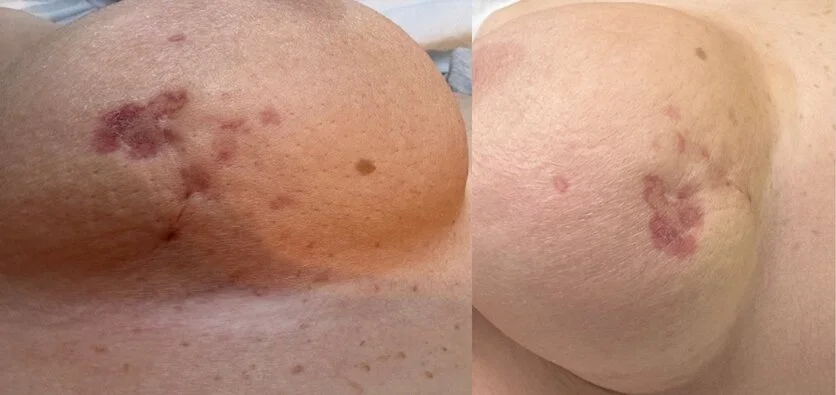 RIAS Patientin A (rechte Brust) Bild 1 und 2, © Sarkomzentrum der Universitätsmedizin Mannheim Zwei klinische Fotografien einer rechten Brust aus verschiedenen Blickwinkeln, die großflächige, rötlich-violette Hautverfärbungen und eine kleine Narbe zeigen.
