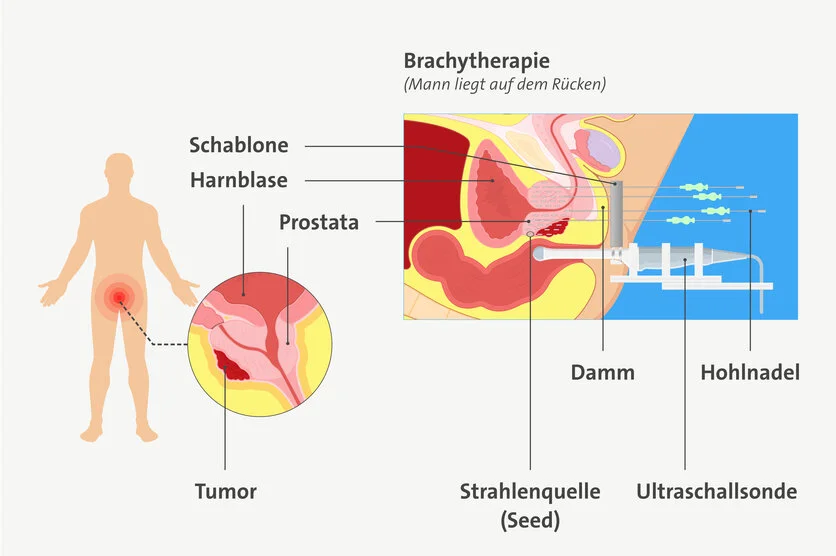 Brachytherapie bei Prostatakrebs , © Pepermpron, Shutterstock (Grafik: redaktionell bearbeitet) Grafische Darstellung einer LDR Brachytherapie bei Prostatakrebs: Dafür bekommt der Patient reiskorngroße Strahlenquellen (Seeds) mithilfe von Hohlnadeln in die gesamte Prostata eingebracht.