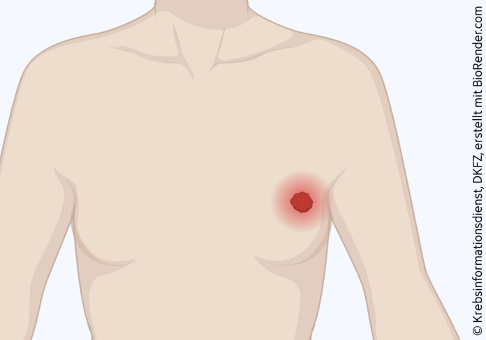 Grafische Darstellung eines Tumor in der weiblichen Brust, der rot hinterlegt ist.