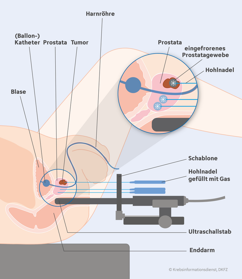 Fokale Kältetherapie bei Prostatakrebs, © Krebsinformationsdienst, DKFZ; erstellt von Anna Diechtierow Grafische Darstellung der fokalen Kältetherapie (Kryotherapie) bei Prostatakrebs.