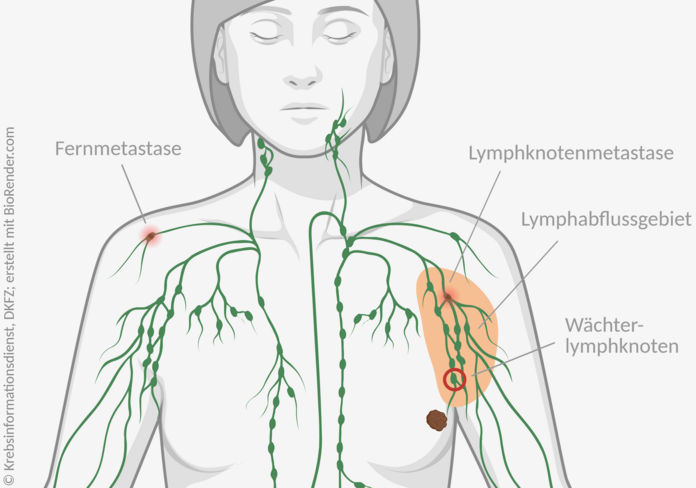 Anatomische Darstellung eines weiblichen Oberkörpers mit einem Tumor in der linken Brust. Das Lymphabflussgebiet ist markiert, darin ist eine Lymphknotenmetastase eingezeichnet. In der entfernten, rechten Schulter ist eine Fernmetastase in einem Lymphknoten dargestellt.