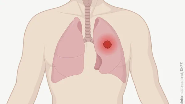 Tumor in der Lunge Grafik eines menschlichen Oberkörpers mit Lunge und Luftröhre. Ein Tumor in der Lunge ist als leuchtender Punkt dargestellt.