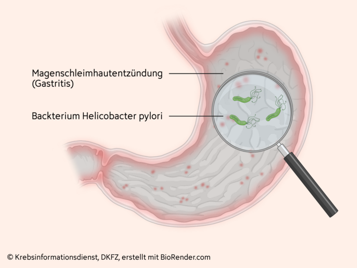 Grafik einer Magenschleimhautentzündung. Die Lupe vergrößert das Bakterium Helicobacter pylori