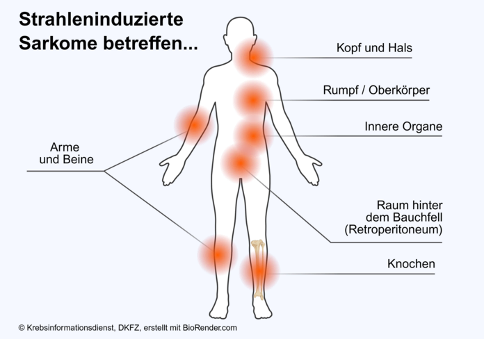 Die Abbildung zeigt eine Körpergrafik mit den Orten, an denen RIS hauptsächlich auftritt: Kopf und Hals, Rumpf, beziehungsweise Oberkörper, innere Organe, Arme und Beine, Raum hinter dem Bauchfell (Retroperitoneum) und Knochen.