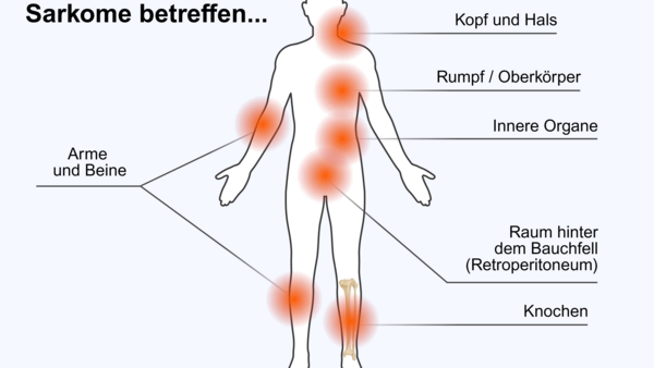 Die Abbildung zeigt eine Körpergrafik mit den Orten, an denen RIS hauptsächlich auftritt: Kopf und Hals, Rumpf, beziehungsweise Oberkörper, innere Organe, Arme und Beine, Raum hinter dem Bauchfell (Retroperitoneum) und Knochen.
