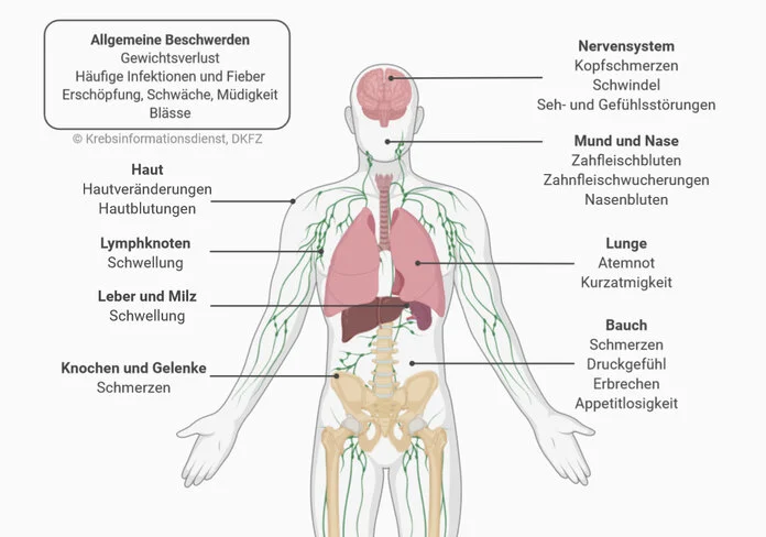 Leukämie-Symptome, © Krebsinformationsdienst, DKFZ; erstellt mit BioRender.com Anatomische Abbildung eines Menschen mit Zuordnung verschiedener Leukämie-Symptome.