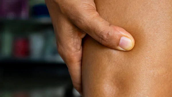 Lymphödem im Bein, © tnkorn yangaun, Shutterstock Foto von einem Lymphödem im Bein: Eine Person drückt mit dem Daumen in eine Wasseransammlung im Bein, wwodurch eine Delle zurückbleibt.