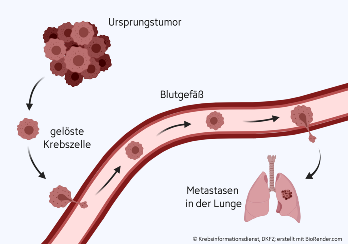 Entstehung Lungenmetastasen, © Krebsinformationsdienst, DKFZ; erstellt mit BioRender.com Tumoren können in die Lunge streuen.