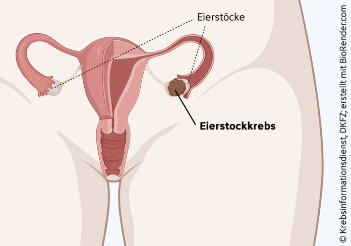 Eierstockkrebs: Tumor im Eierstock, © Krebsinformationsdienst, DKFZ; erstellt mit Biorender.com Darstellung der weiblichen Geschlechtsorgane mit Beschriftung der Eierstöcke.