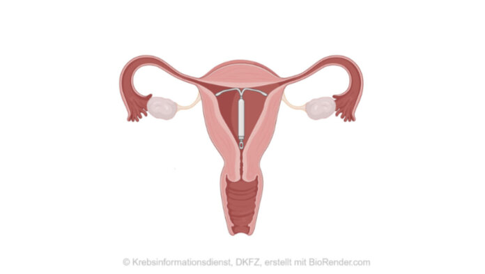 Schematische Darstellung von Scheide, Gebärmutter und Eierstöcken mit in der Gebärmutter liegender Hormonspirale.