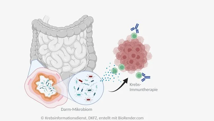 Mikrobiom und Immuntherapie bei Krebs, © Krebsinformationsdienst, DKFZ, erstellt mit BioRender.com Zu sehen ist der Dickdarm in einem angedeuteten Körper. Ein Darmabschnitt ist vergrößert und das Innere ist zu sehen. Darin sieht man durch ein Vergrößerungsglas stäbchenförmige Bakterien. Neben dem Körper ist ein Haufen mit roten Zellen, die einen Tumor darstellen. Zwischen Tumor und Darmbakterien sind grüne Zellen. Sie stellen eine Krebs-Immuntherapie dar.