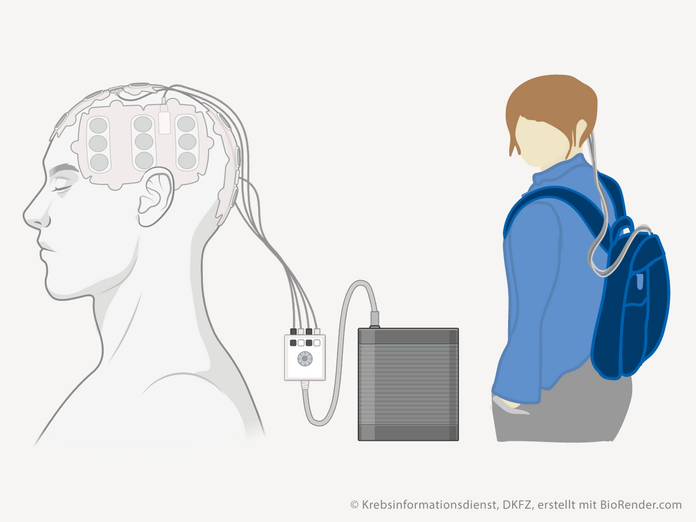 Glioblastomtherapie mit Tumortherapiefeldern (TTFields), © Krebsinformationsdienst, DKFZ, erstellt mit BioRender.com Grafische Darstellung eines Kopfes mit auf die Kopfhaut geklebten Transducer Arrays, die über Kabel mit dem Feldgenerator verbunden sind. Daneben Darstellung einer Person mit Perücke und Kabeln, die vom Kopf zu einem Rucksack führen.
