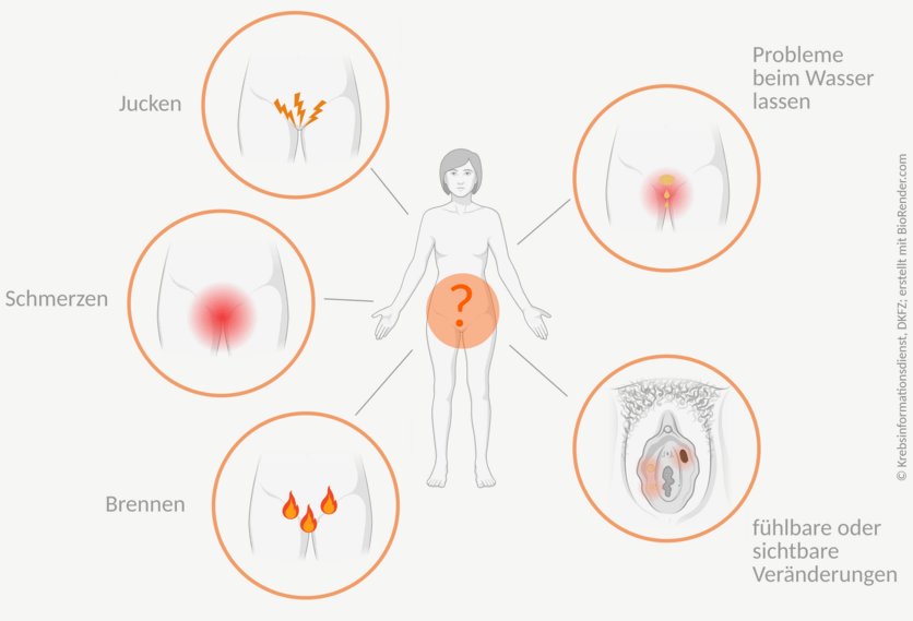 Beschwerden bei Vulvakrebs, © Krebsinformationsdienst; DKFZ; erstellt mit BioRender.com Grafische Darstellung von Beschwerden bei Vulvakrebs. Mögliche Symptome sind: Brennen, Jucken, Schmerzen und sichtbare oder fühlbare Veränderungen der Vulva sowie Probleme beim Wasser lassen.