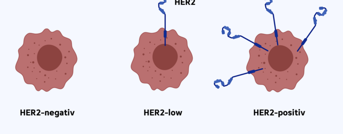 Brustkrebszellen mit keinem, wenig und viel HER2 auf der Zelloberfläche. Die Krebszelle mit wenig HER2 wird als HER2-low bezeichnet.