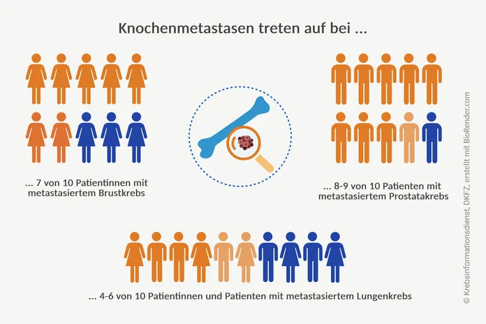 Grafische Darstellung: Knochenmetastasen treten auf bei 7 von 10 Patientinnen mit metastasiertem Brustkrebs, 8 bis 9 von 10 Patienten mit metastasiertem Prostatakrebs und bei 4 bis 6 von 10 Erkrankten mit metastasiertem Lungenkrebs.